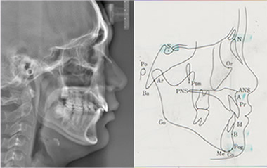 頭部Ⅹ線規格写真（セファログラム）